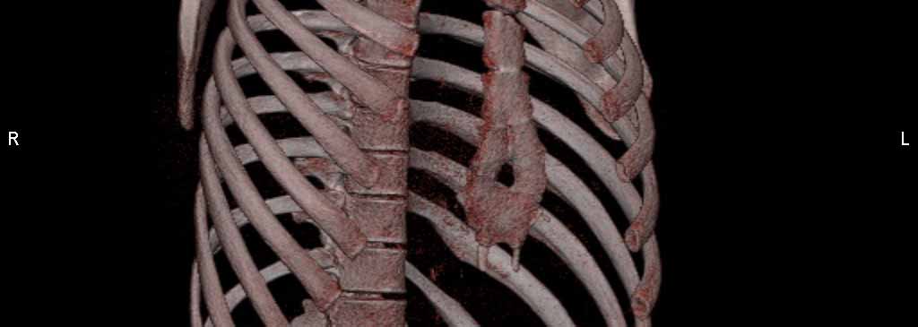 brustwand_Fehlbildung3jpg