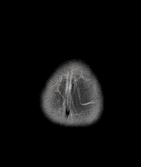 Gehirntumor_Kinder Gehirntumor_Kinder