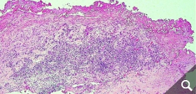 Diffuse Lymphozyteninfiltration in der Gelenkkapsel